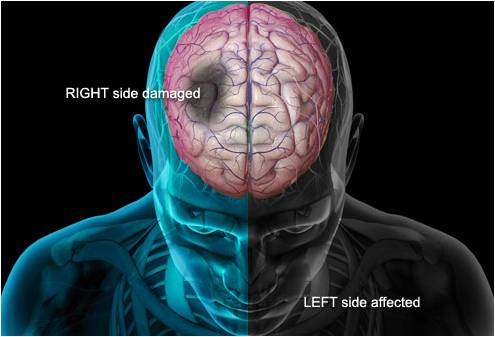 Effects of a Stroke on a Brain